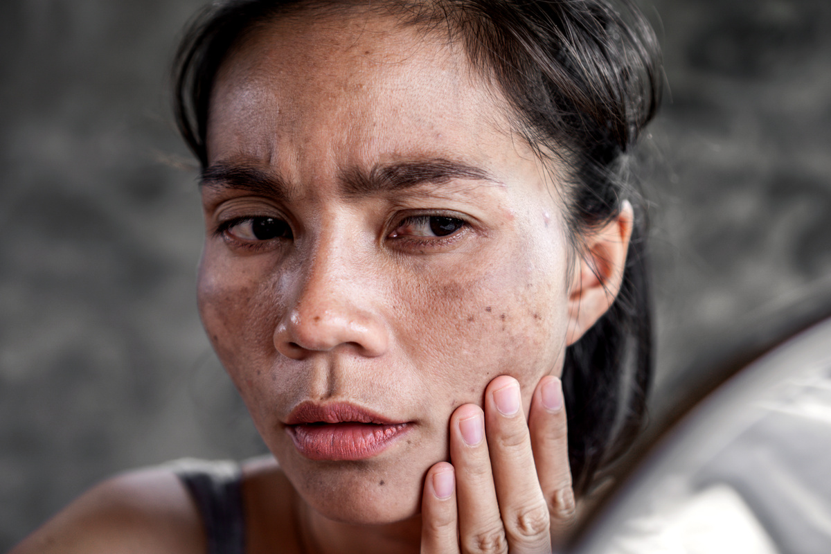 Asian woman having  skin condition problem with melasma, dark spot, freckle on face from uv light
